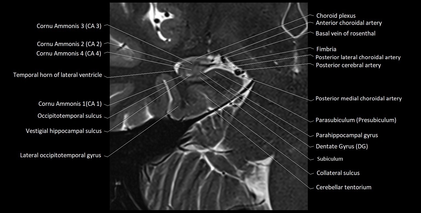 Hippocampus anatomy mri coronal cross section 3T MRI image 8.webp